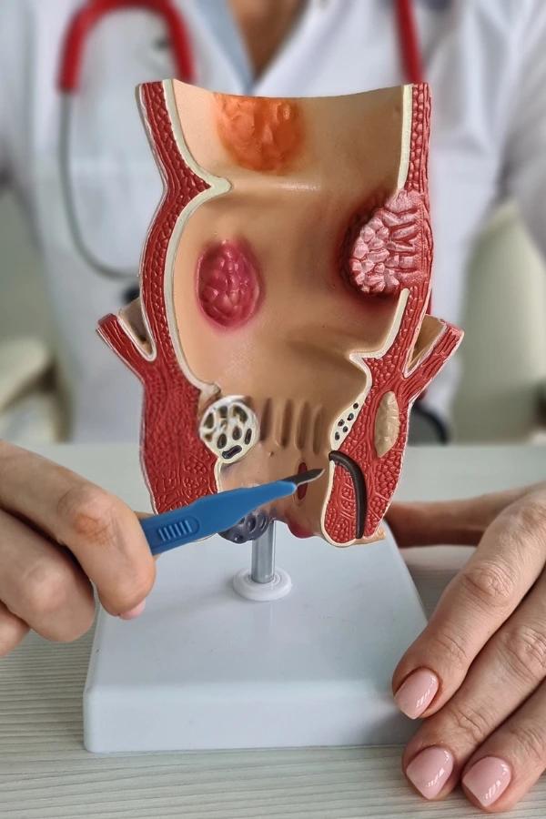 Cirugía de Fístula Anal En Chetumal