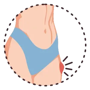 Operación de Hernias en Chetumal