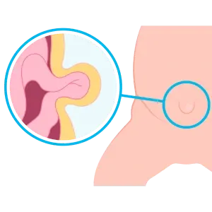 Operación de Hernias en Chetumal